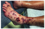 imagenes_comentadas:leukocytoclastic_vasculitis_after_covid-19_vaccine_booster.png