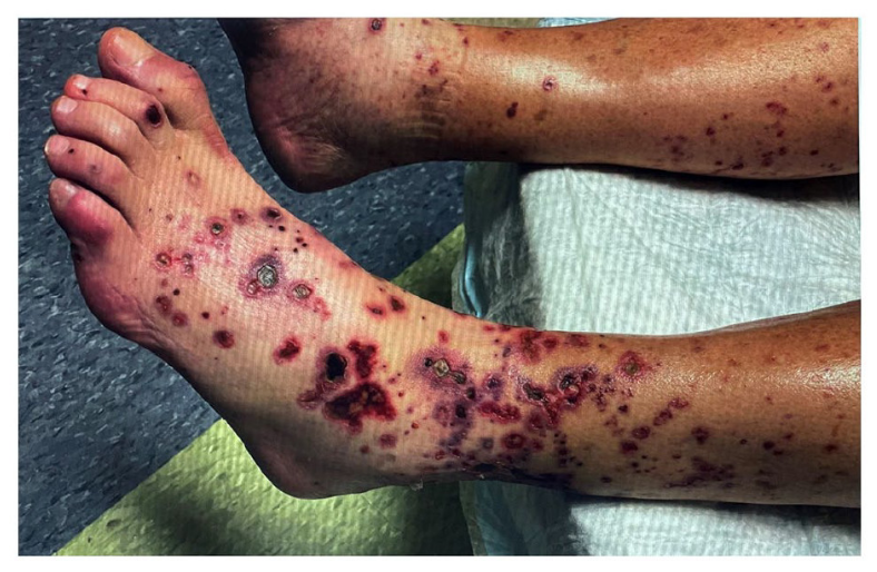leukocytoclastic_vasculitis_after_covid-19_vaccine_booster.png leukocytoclastic_vasculitis_after_covid-19_vaccine_booster.png