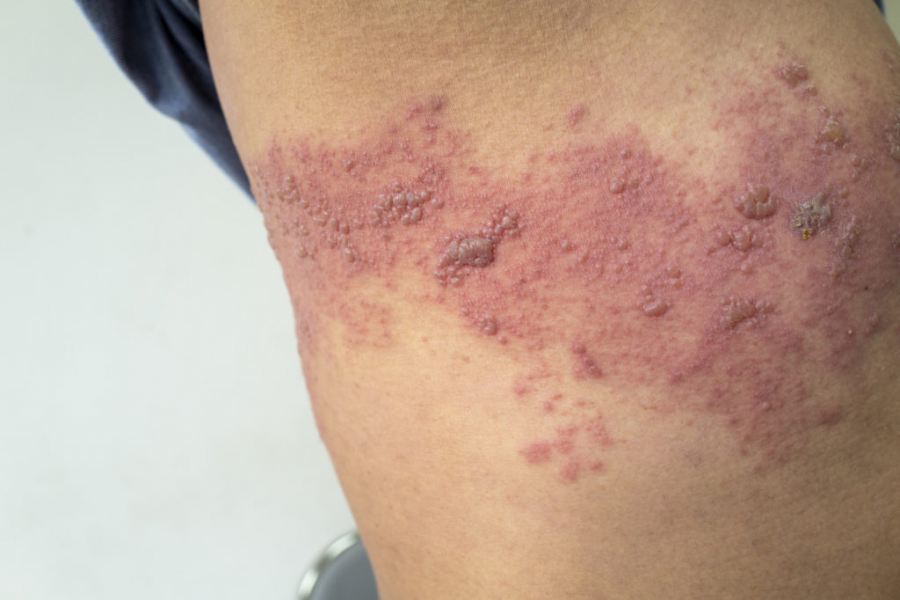 herpes_zoster.png herpes_zoster.png